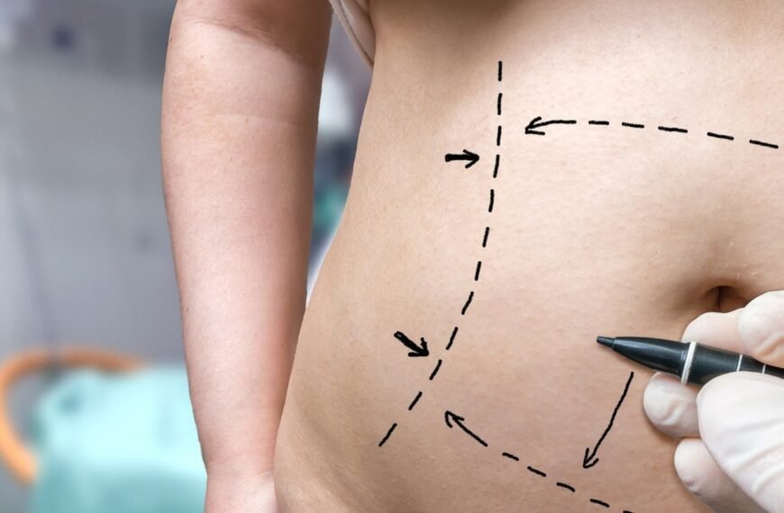 Coolsculpting