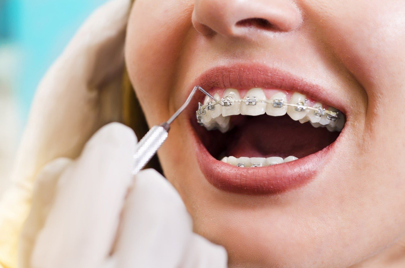 Should I Get Braces