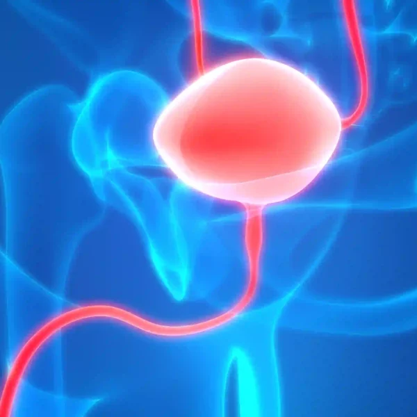 urethral stricture