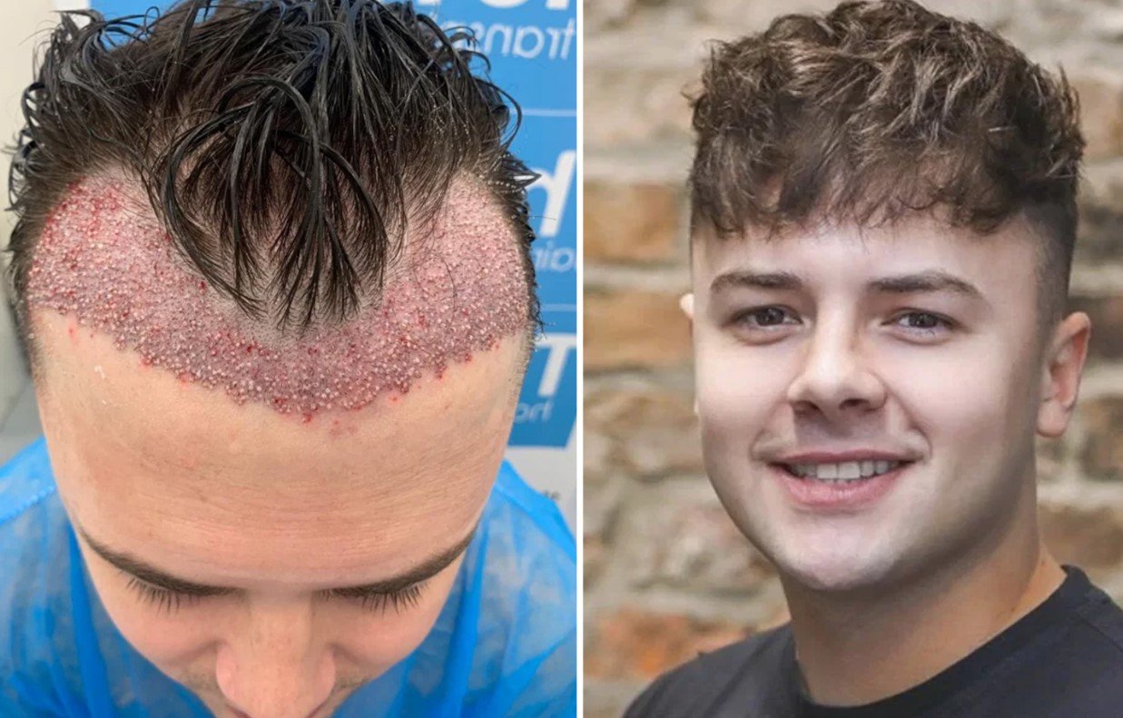 Hair transplant